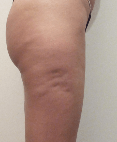 Complete Cellulite Treatment Sydney