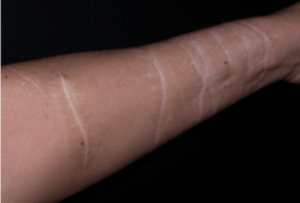 How to get rid of self harm scars - Specialist laser self harm scar removal