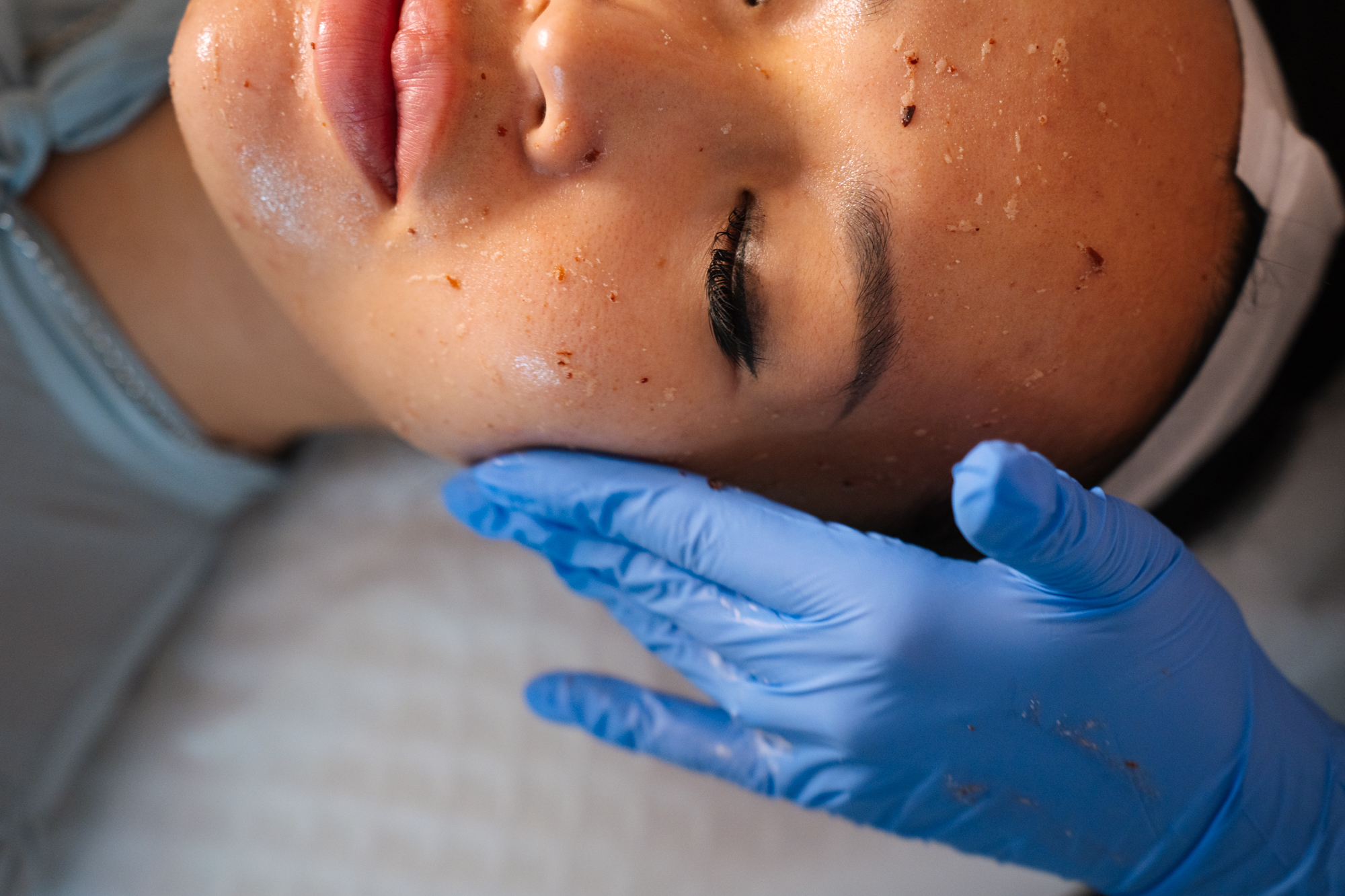 Laser Facial in Crows Nest