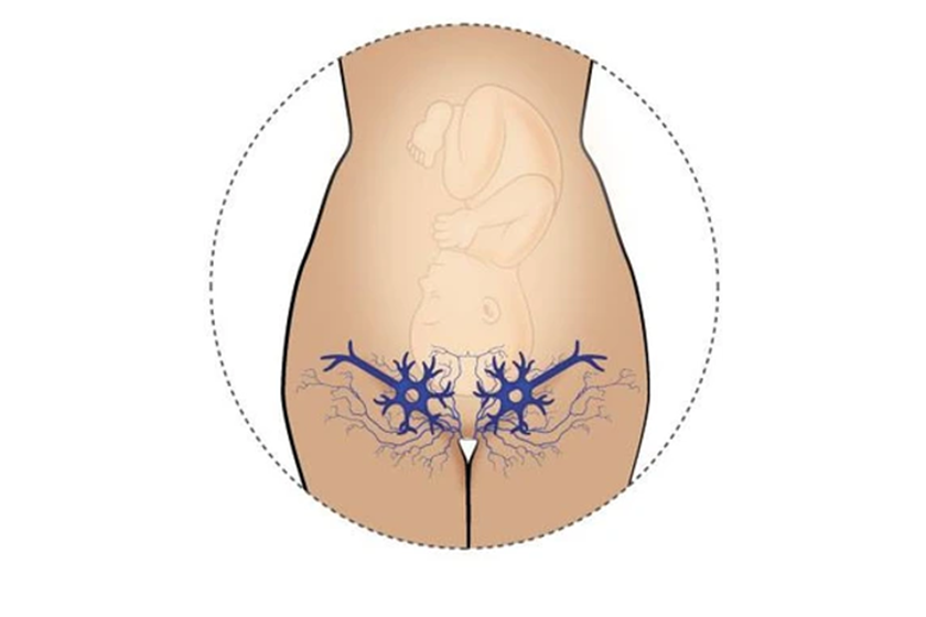 labial varicose veins