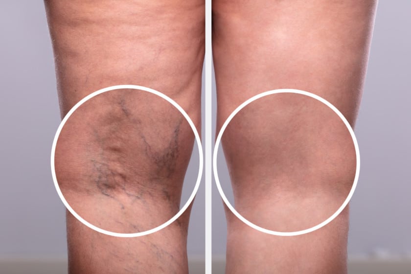 Varicose Veins Contour Cosmetic Clinics