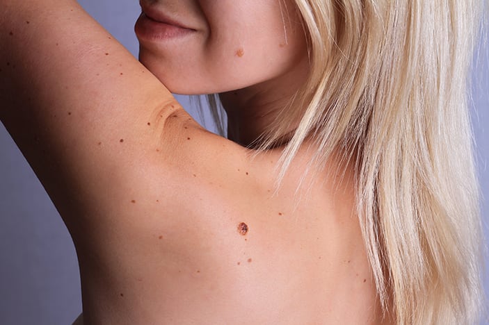 Woman looks at moles on her back worried about melanoma skin cancer