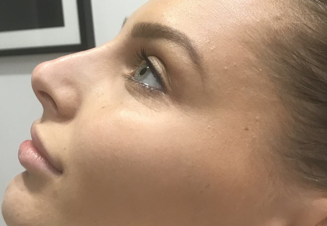 After non surgical rhinoplasty