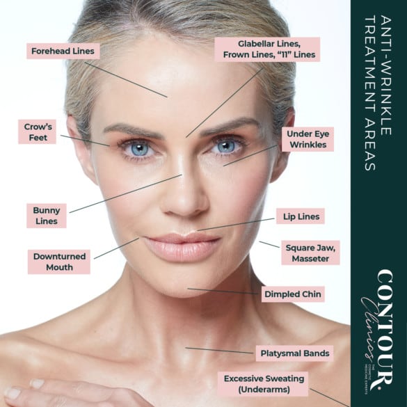 anti wrinkle injections under eyes