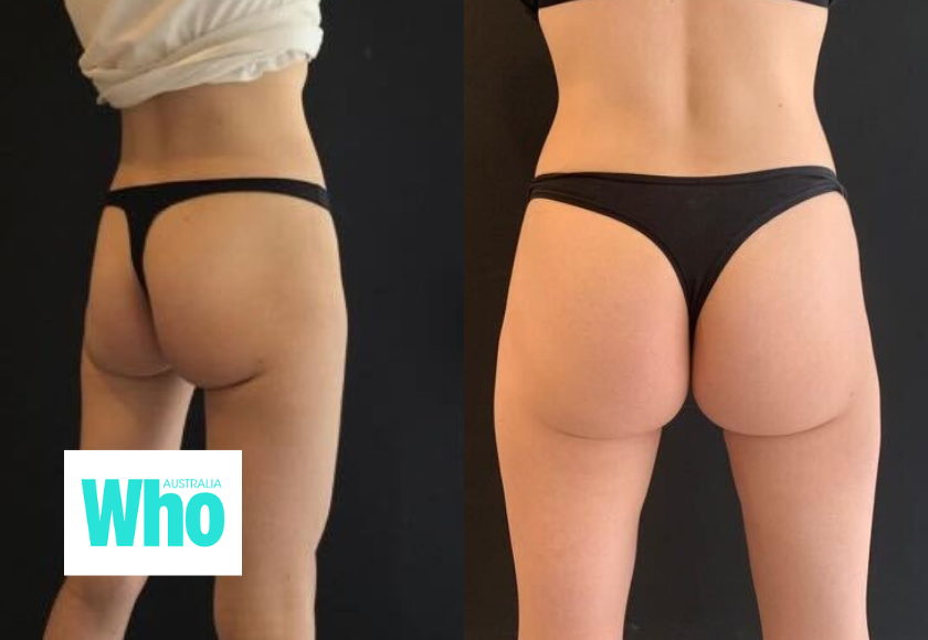 WHO Magazine: The Non-Surgical Butt Lift, In The Media