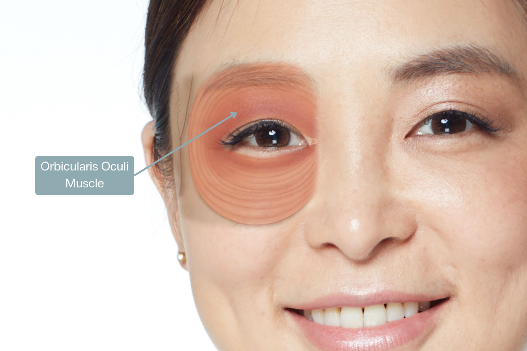 Crows feet botox sydney