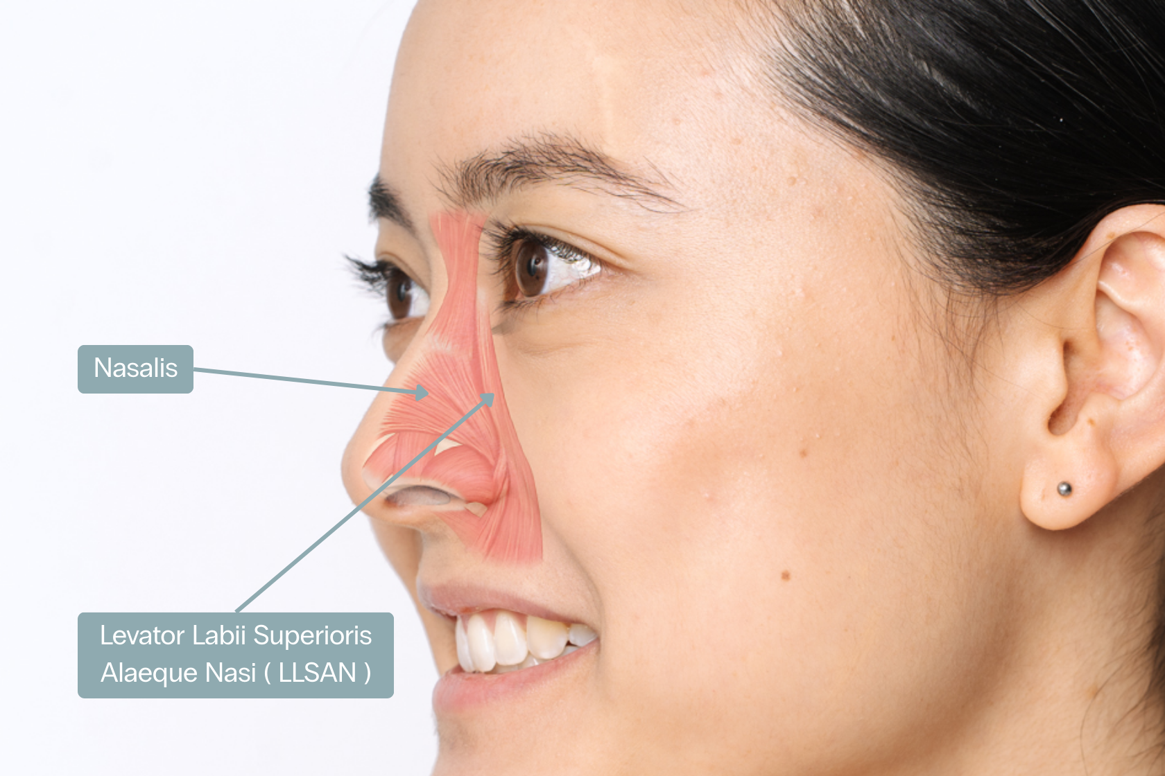 bunny line or nasal scrunch botox