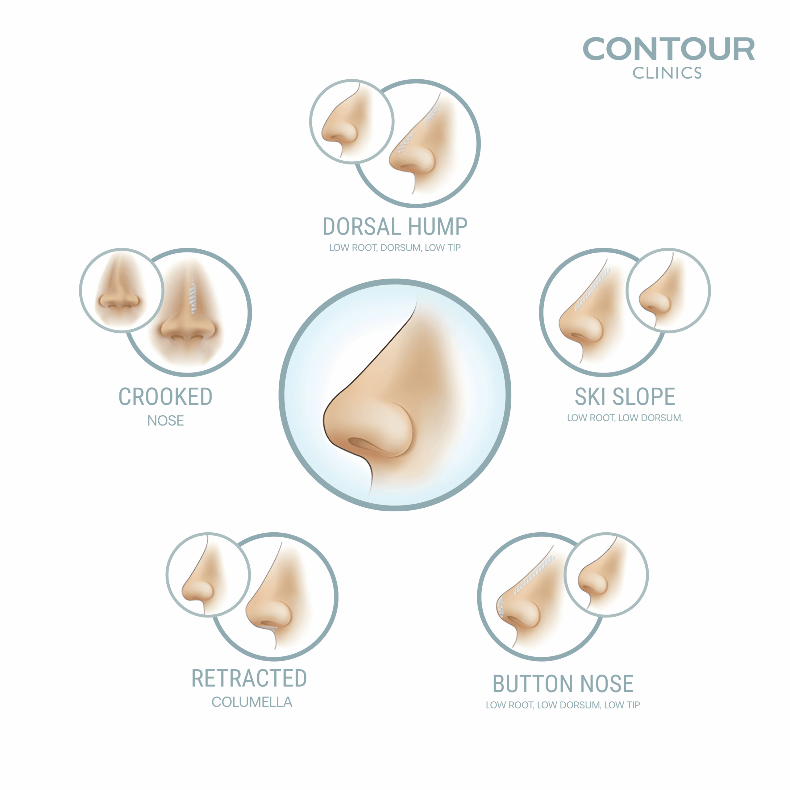 Nose filler by Contour Clinics