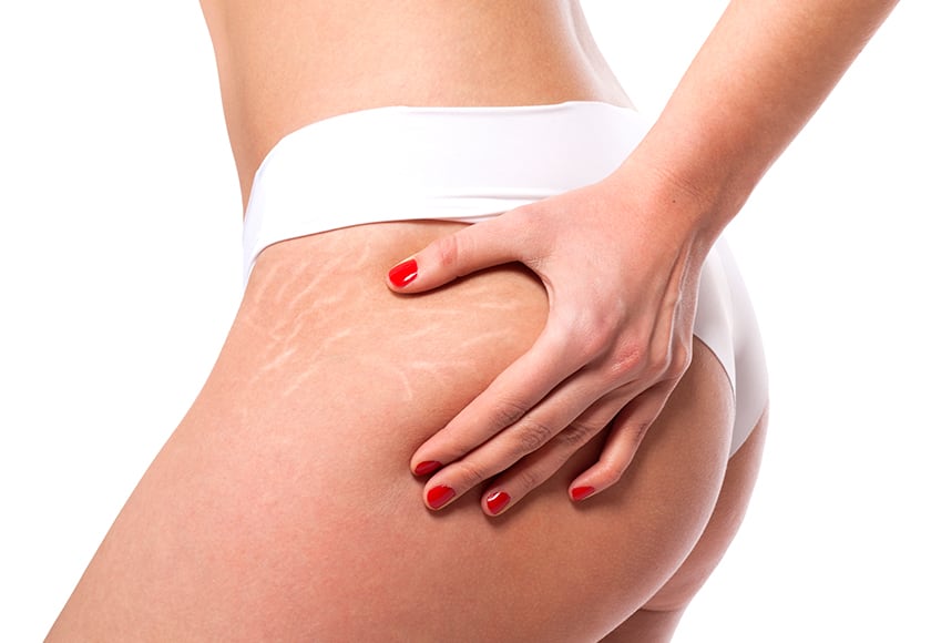 Specialist Stretch Mark Removal Clinic Sydney - Post pregnancy Expertise